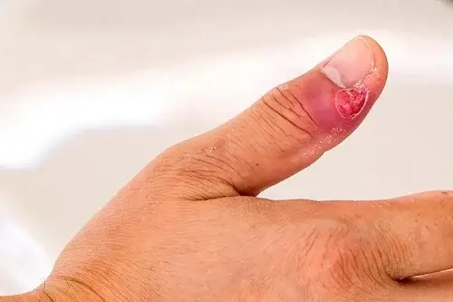 عوارض کاشت ناخن با ژل: عفونت ناخن